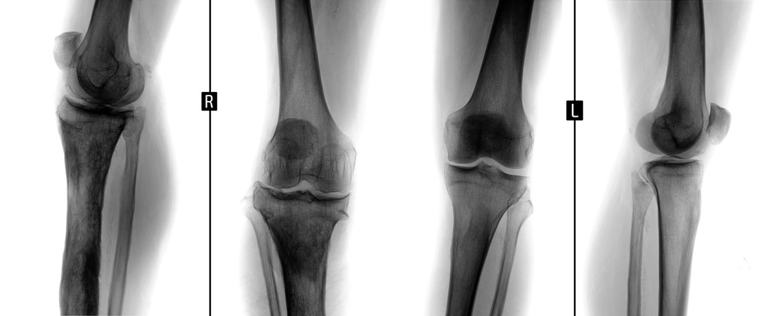 dolor-rodilla-cronico-p