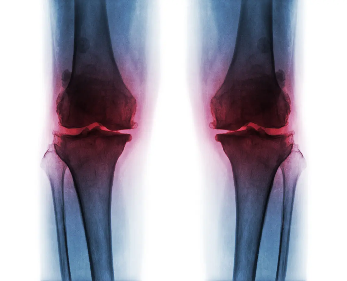 artrosis-rodilla-radiografia