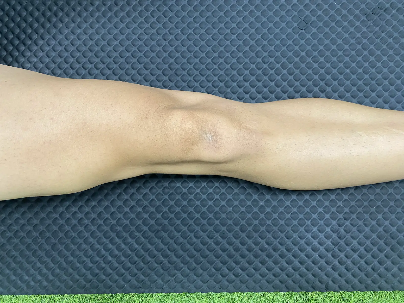 tendinitis-o-desgarro-muscular